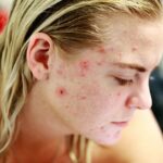 Say Goodbye to Acne: Your Ultimate Guide to Preventing Skin Breakouts